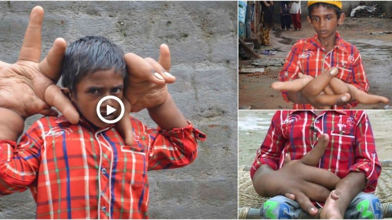 A Tale of Hardship: The Extraordinary Journey of a Boy with Giant Hands