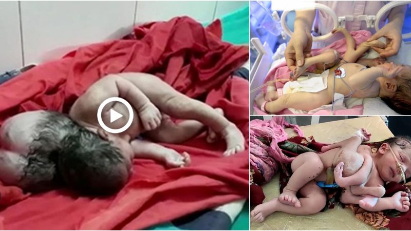 Newborn baby with 3 heads was born, Indian villagers bowed down for the incarnation of the god