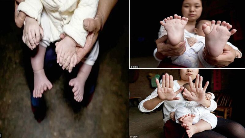 Strange baby: 31 fingers and toes in Hong Kong