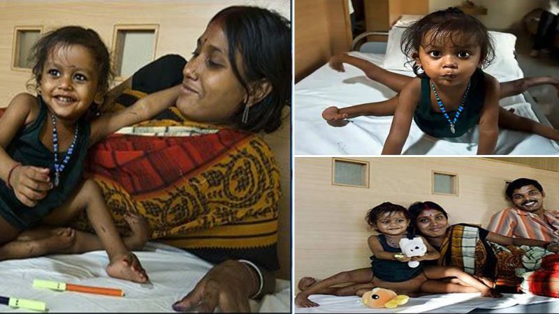 Born Different, Former 8 Limbed Girl Thriving, Playing Sports in School