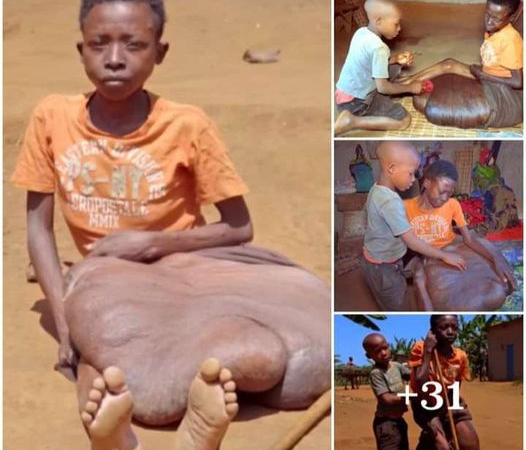 The Inspiring Journey of an 8-Year-Old Boy Caring for His Friend with a Giant Leg