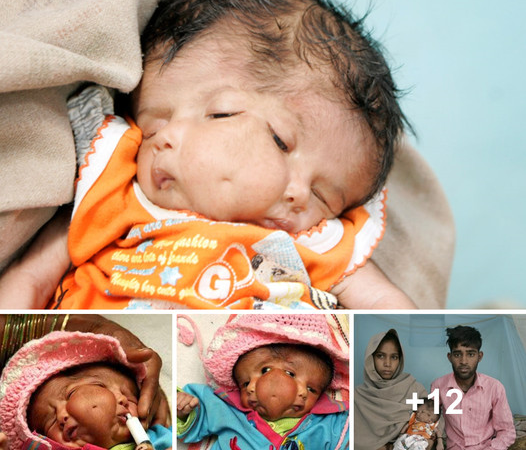 A Miraculous Birth: Indian Baby with Two Faces Raises Speculation and Awe