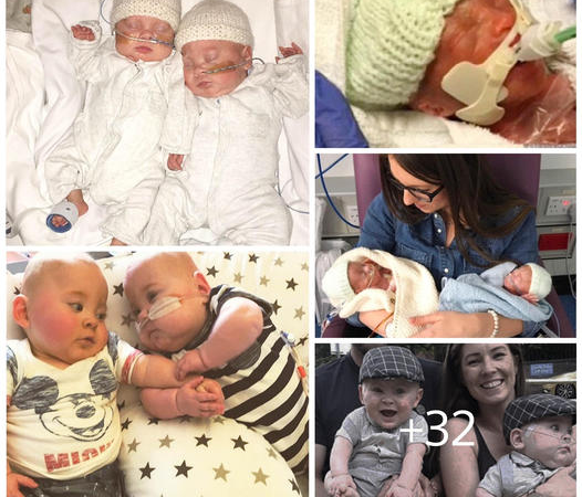 Miracle Minis: A Remarkable Recovery of Two 24-Week-Old Infants