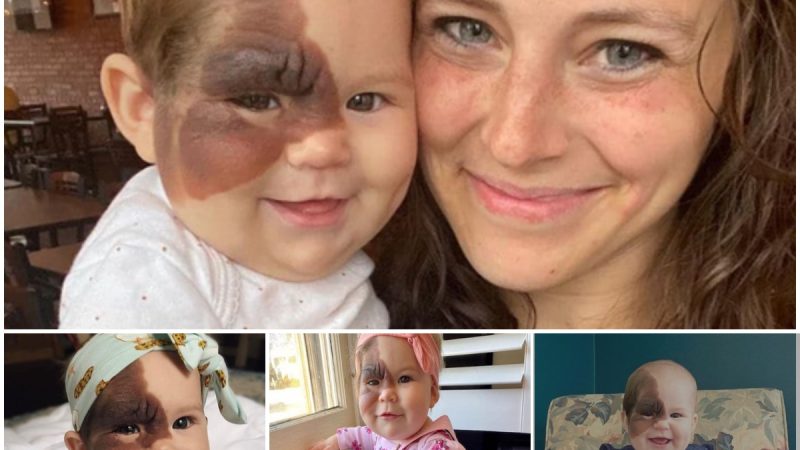 Celebrating Uniqueness: The Beautiful Baby Girl with a Rare Birthmark