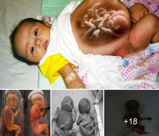 Newborn Girl’s Arrival Reveals Astounding Simultaneous Pregnancy.