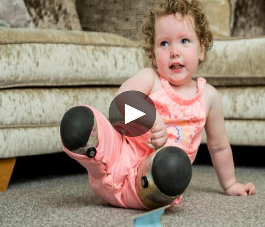 Heartbreaking Decision: Parents Choose to Amputate Two-Year-Old Daughter’s Legs After Years of Painful Surgeries