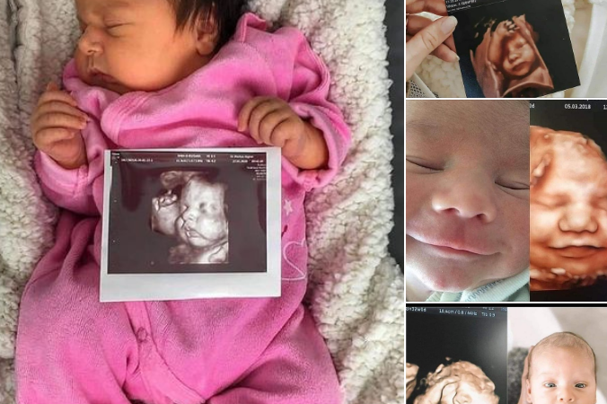 A Miraculous Surprise: Identical Ultrasound and Birth