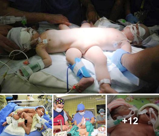 Miracle in Medicine: Conjoined Twins with Shared Digestive System Successfully Separated in Pioneering Nine-Hour Surgery