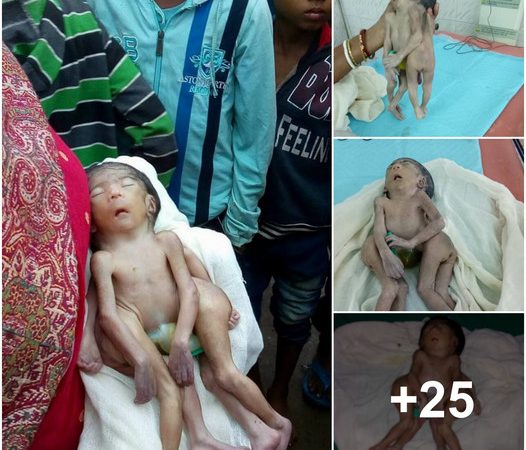 A Remarkable Tale: The Indian Boy Born with Four Legs and Two Penises