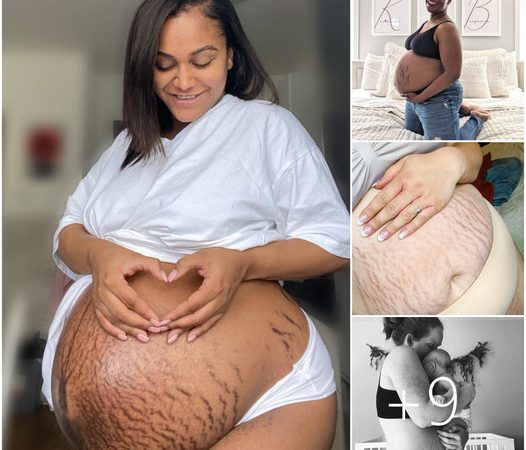 Embracing Beauty Beyond the Surface: Celebrating the Journey of Stretch Marks