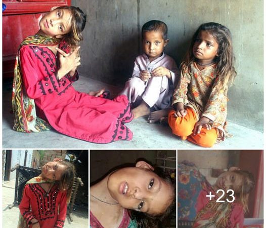 The Ongoing Struggle of Afsheen: A 9-Year-Old Pakistani Girl with a Rare Spinal Disorder